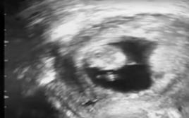 Шокирующий случай медицины: окаменелый ребенок в утробе матери