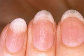 Как определить состояние здоровья по ногтям (11 признаков) Какие болезни может определить по ногтям