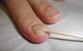 Choroby paznokci: ich charakter i metody leczenia