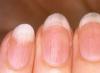 Kako odrediti zdravstveno stanje po noktima (11 znakova) Koje se bolesti mogu prepoznati po noktima