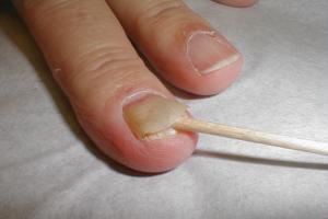 Болести на ноктите: тяхната природа и методи на лечение