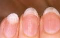 손톱으로 건강 상태를 확인하는 방법 (11 징후) 손톱으로 확인할 수있는 질병